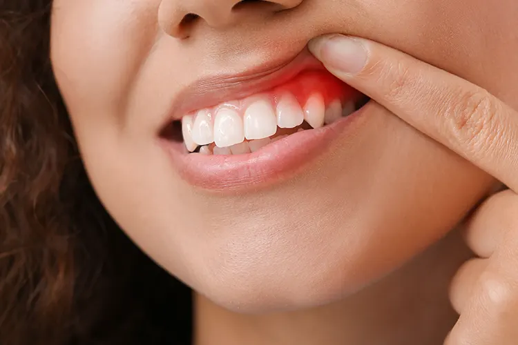 DENTAL ABSCESS