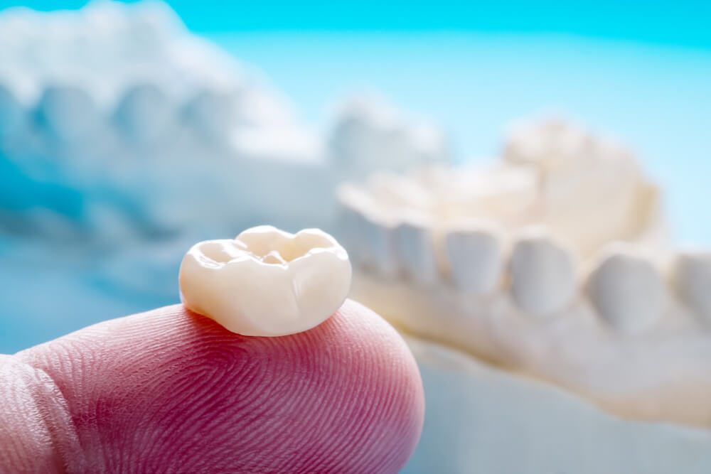You are currently viewing Can You Whiten Dental Crowns?