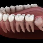 Does Pineapple Juice Speed Up Wisdom Tooth Recovery?