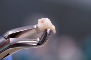 Read more about the article How Long After a Tooth Extraction Can I Eat?