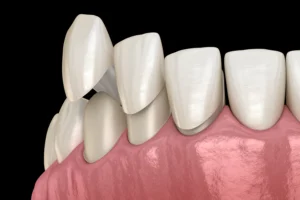 Read more about the article Porcelain vs. Composite Veneers: Which is the Right Choice for You?