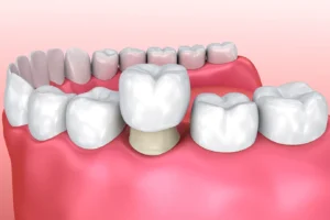 Read more about the article What to Expect After Getting a Dental Crown: Care and Maintenance Tips