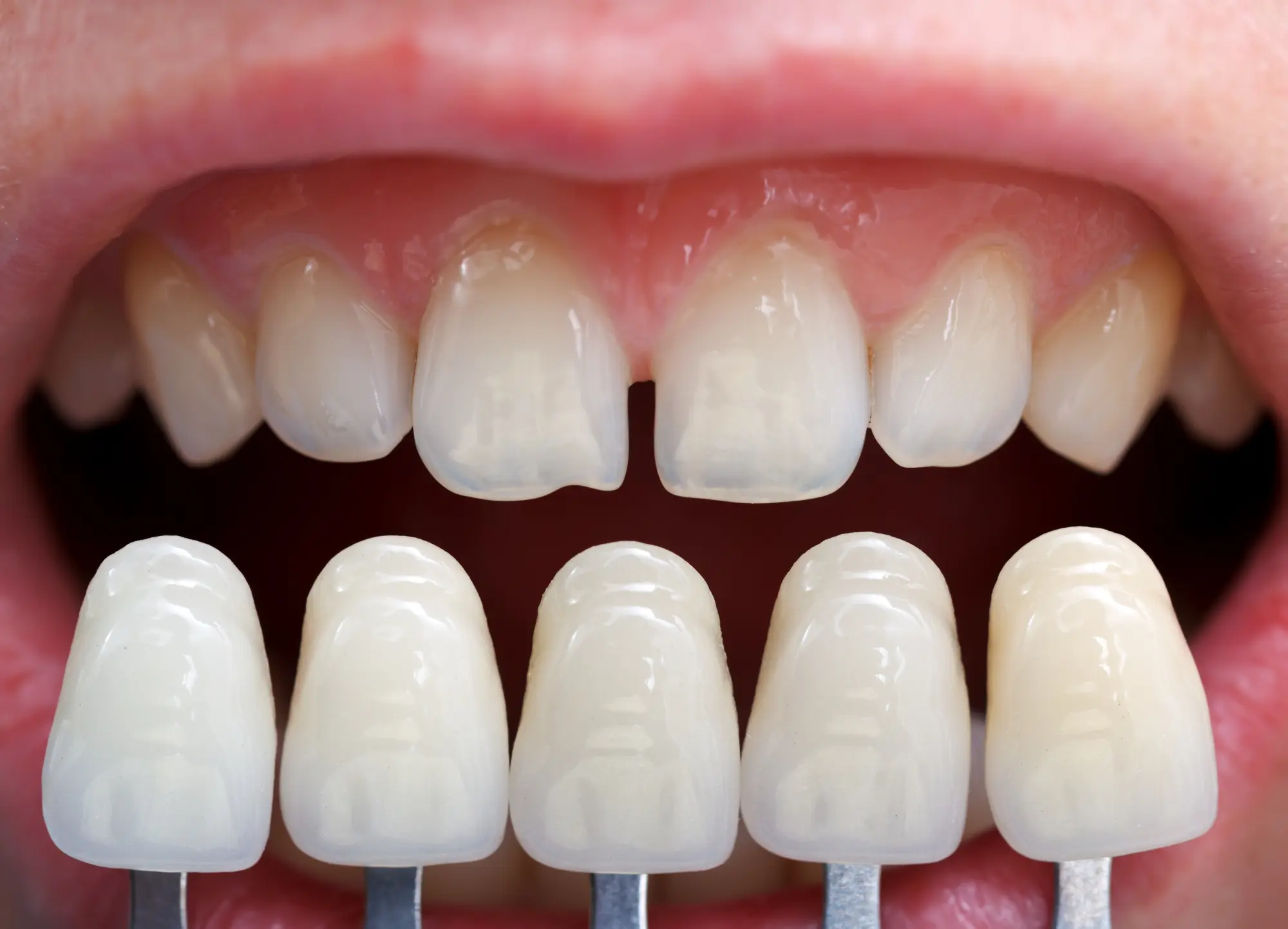 You are currently viewing Can Veneers Correct Gaps Between Teeth?